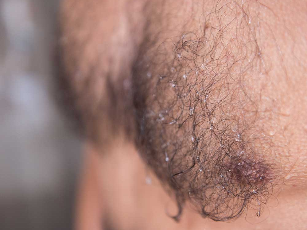 Body Hair Transplant