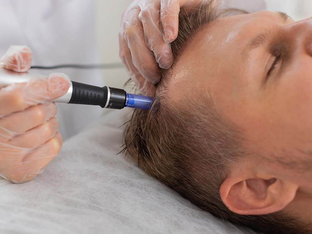 Close up of a patient lying down receiving treatemt to their hair from a practitioner using a medical tool. This image is being used to represent Exosome Hair Therapy.