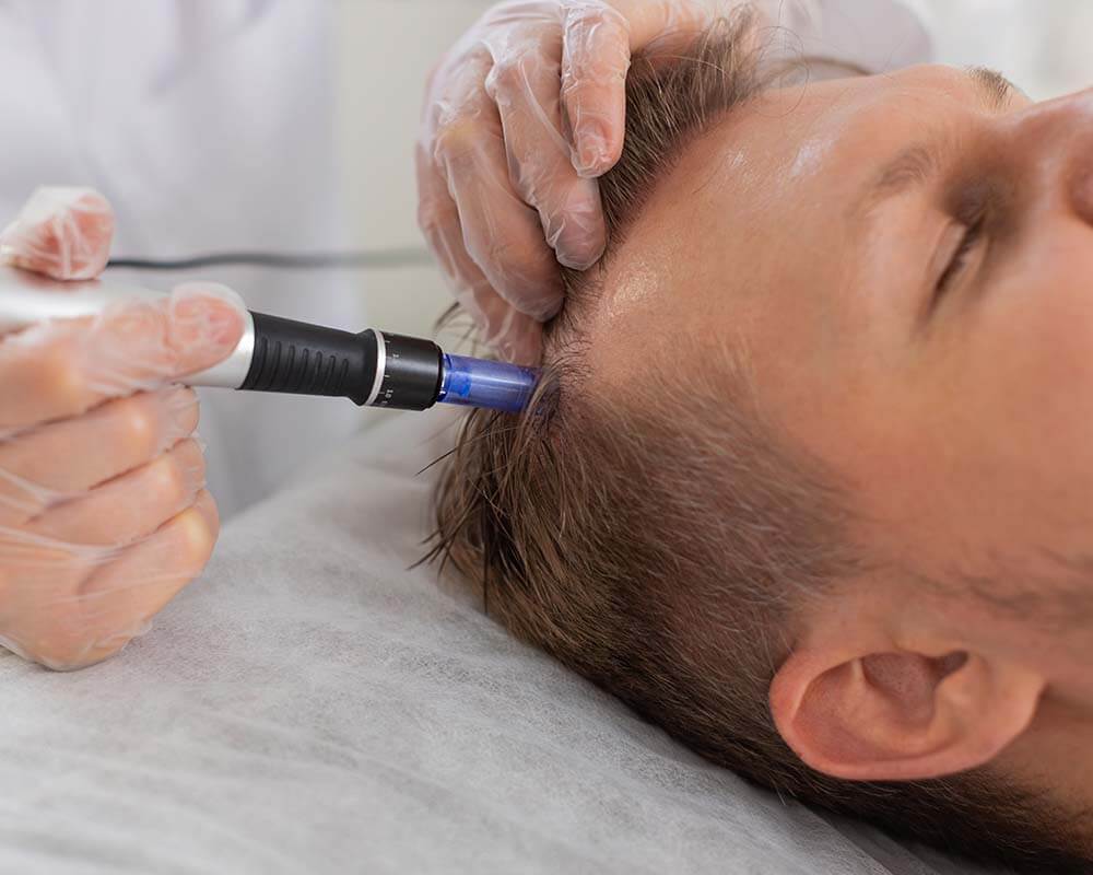Close up of a patient lying down receiving treatemt to their hair from a practitioner using a medical tool. This image is being used to represent Exosome Hair Therapy.