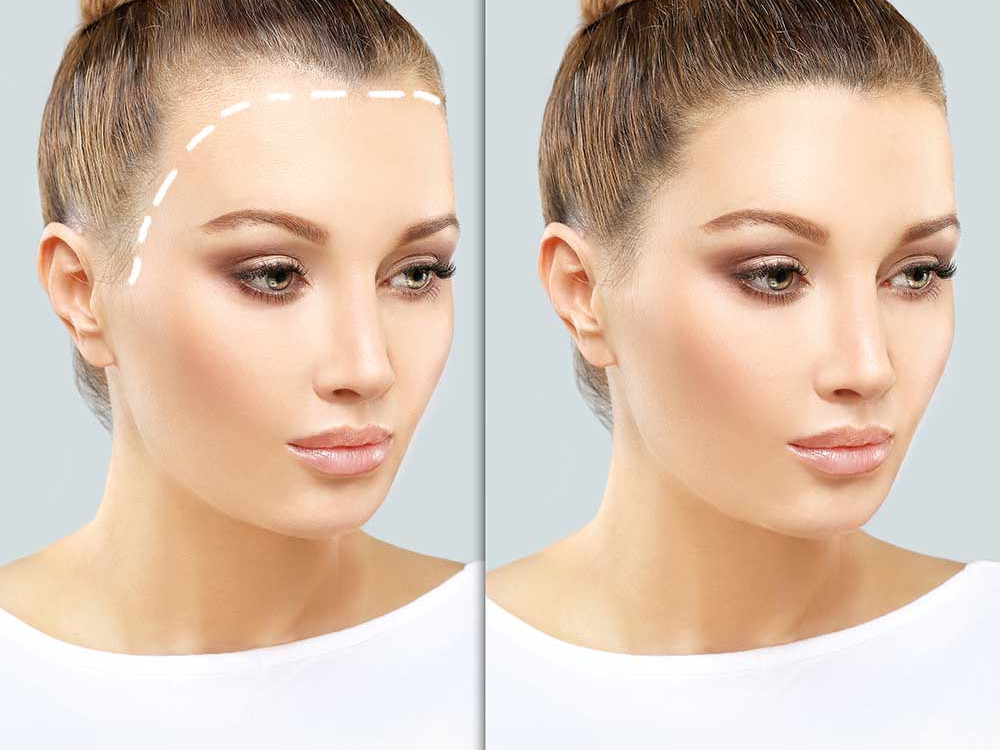 Forehead Reduction Surgery