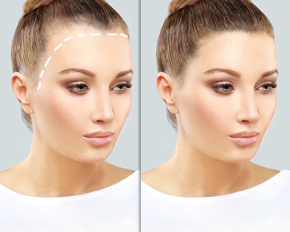 Forehead Reduction Surgery