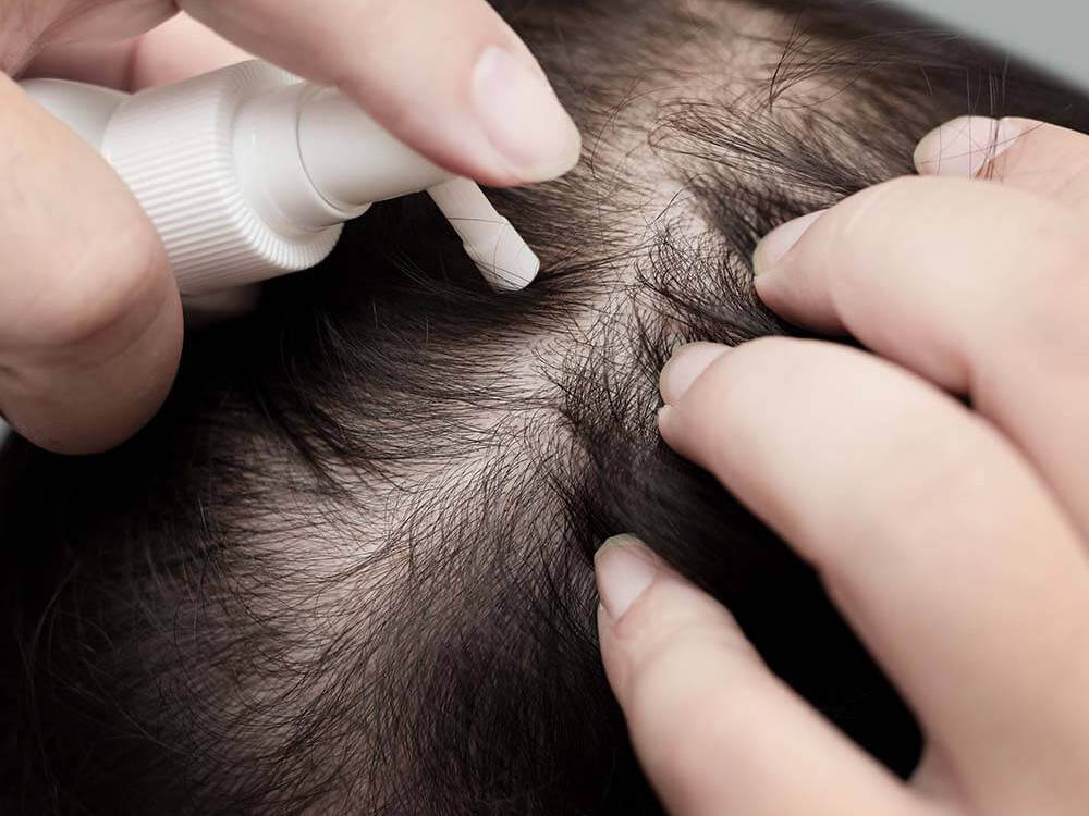 A close up image of someone applying a liquid to their scalp. This image is being used to represent Hair Loss Medication.