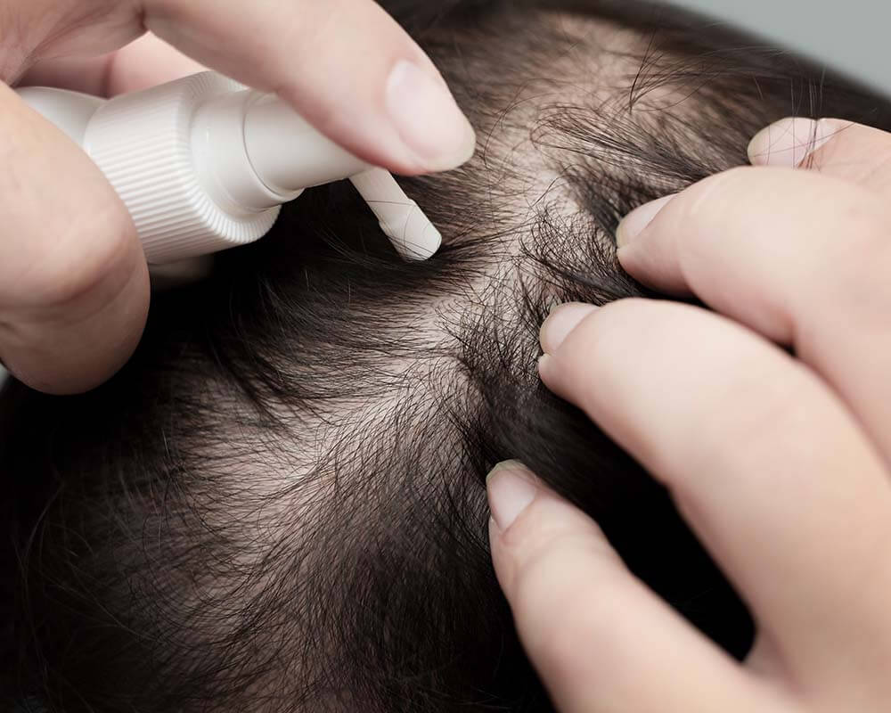 A close up image of someone applying a liquid to their scalp. This image is being used to represent Hair Loss Medication.