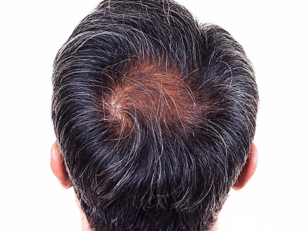 A photo of the back of a man's head, showing an area where the hair coverage is thinning. This image is being used to represent Male Pattern Baldness