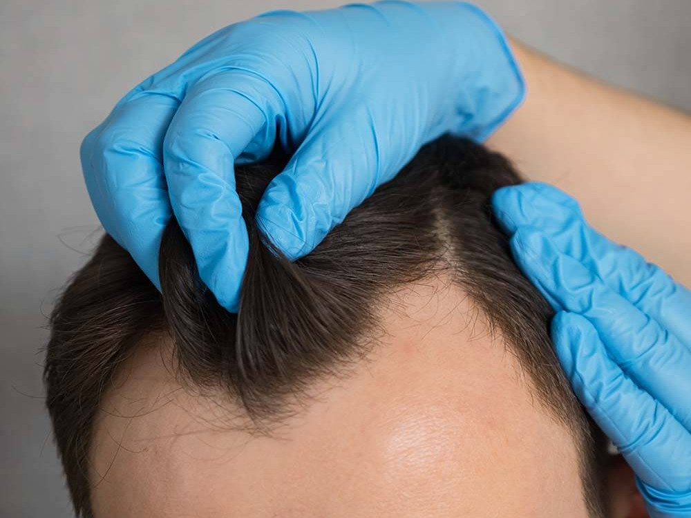 FUE Hair Transplant for Receding Hairline