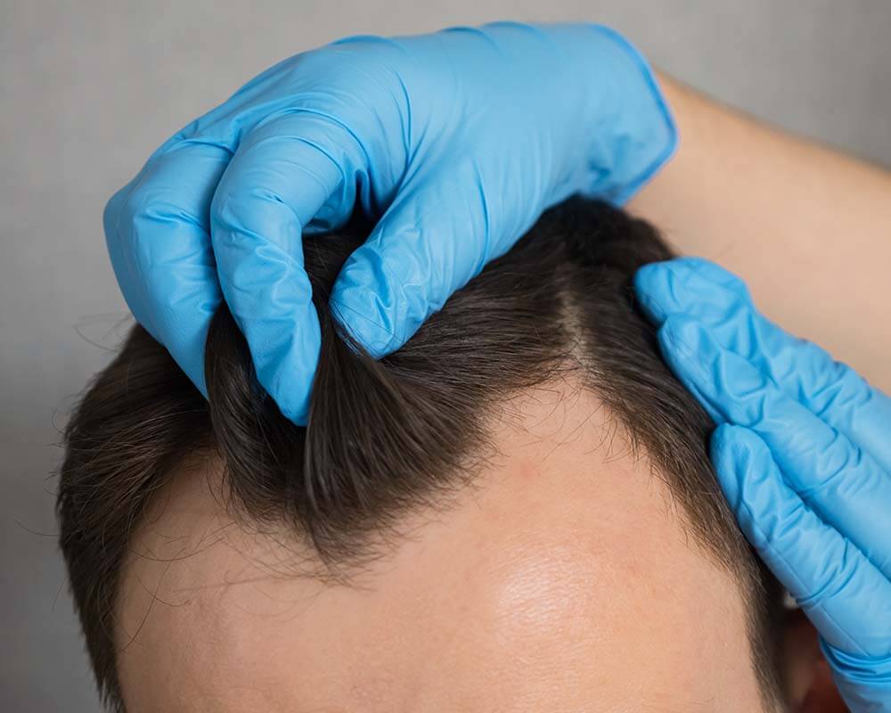 FUE Hair Transplant for Receding Hairline