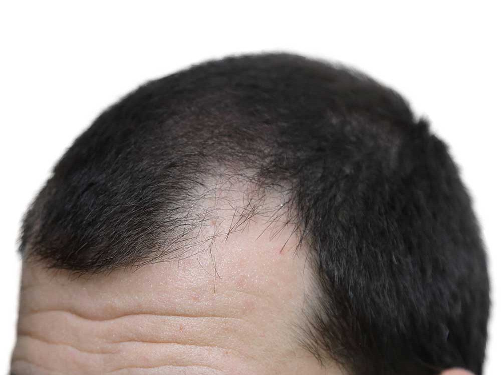 Revision and Repair Hair Transplant