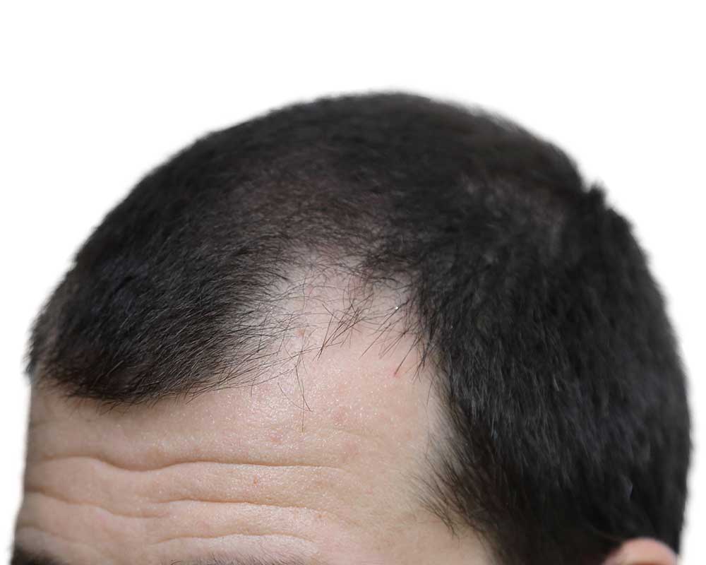 Revision and Repair Hair Transplant