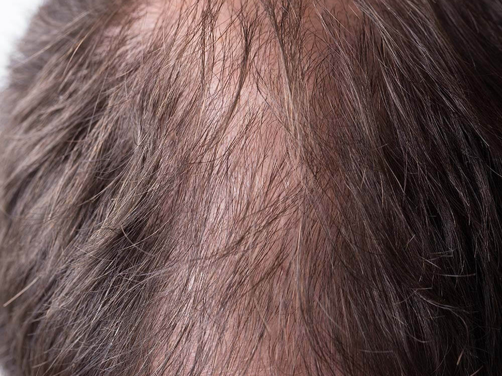 A close-up image of the top of a man's head with a visibly thinning area. this image is being used to represent Hair Regrowth Medications and Biostimulants