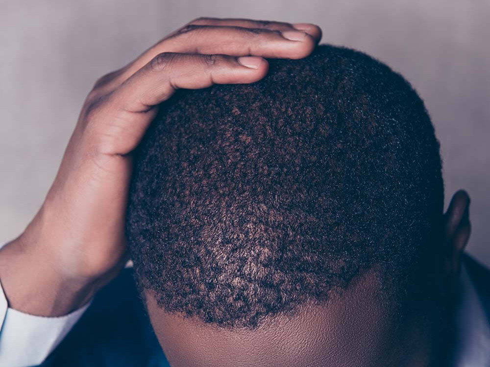 Afro-Textured Hair Transplant