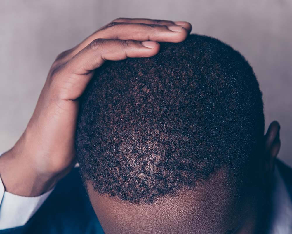 Afro-Textured Hair Transplant