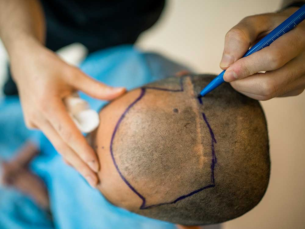 Scar Tissue Hair Transplant