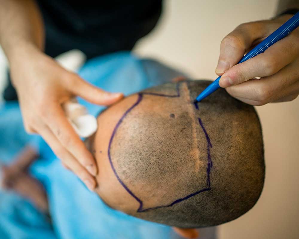 Scar Tissue Hair Transplant