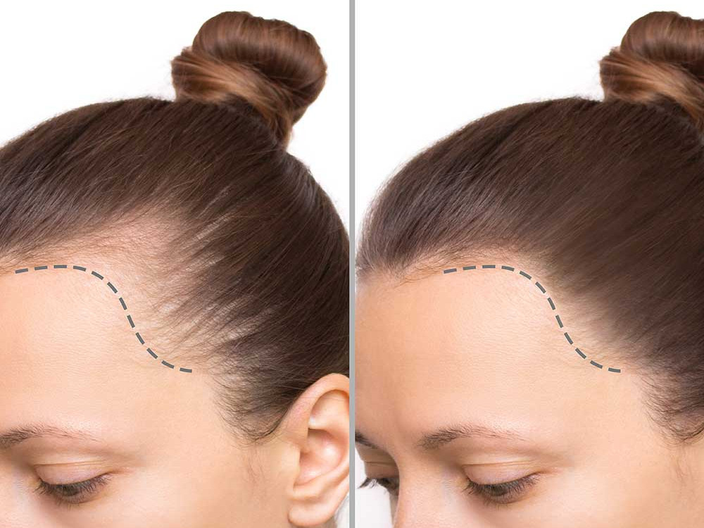 Gender-Affirming Hair Transplant