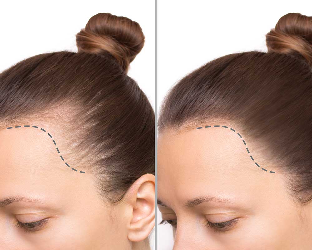 Gender-Affirming Hair Transplant