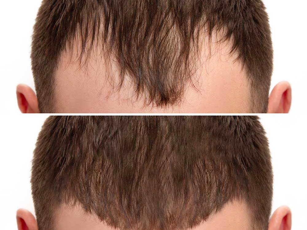 Hairline Lowering