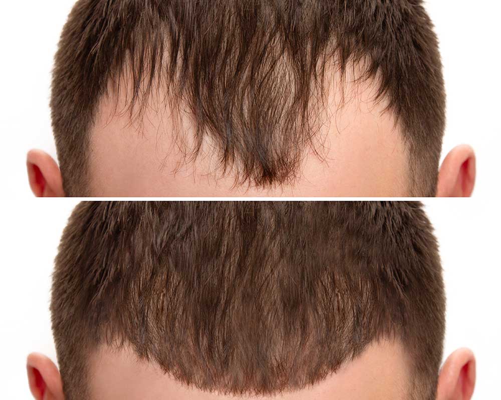 Hairline Lowering